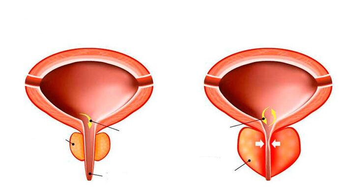 Normal and inflamed prostate