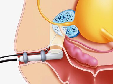 Panning biopsy of the prostate gland