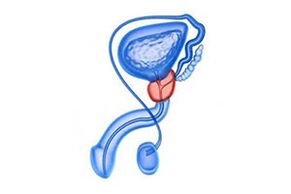 Drawing of prostate inflammation